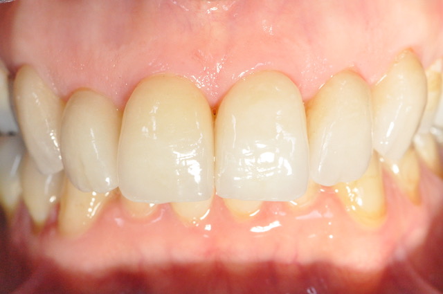 Corona dentale